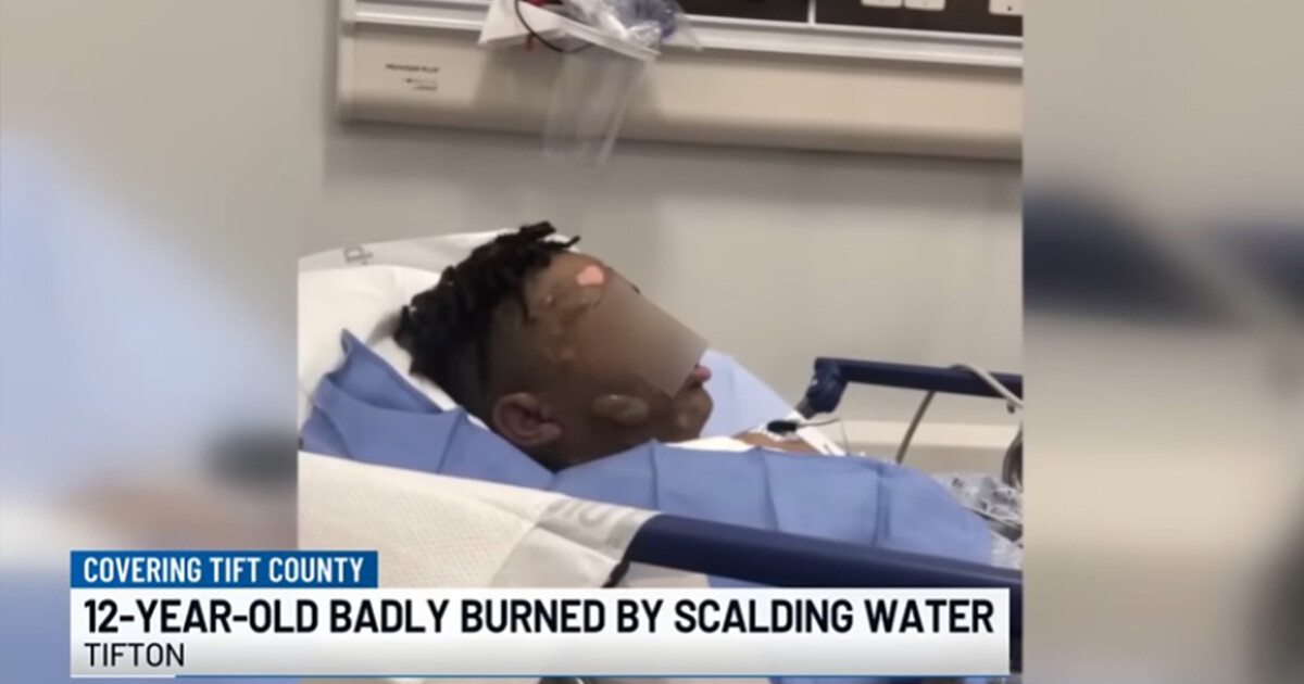 12-Year-Old Georgia Boy Suffers Severe Burns After 3 Friends Pour Boiling Water on Him During Sleepover 'Prank'