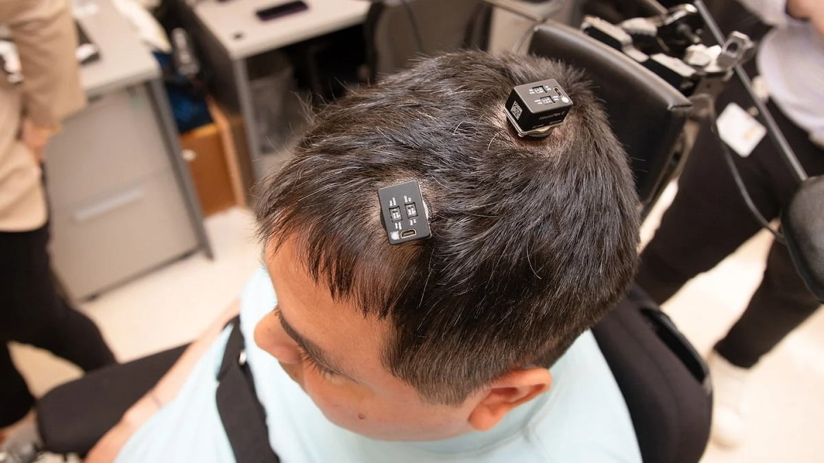 The rigorous process also encompassed the attachment of external openings on Thomas' head. First-of-its-kind AI surgical brain implant helped a man regain feeling in his hand
