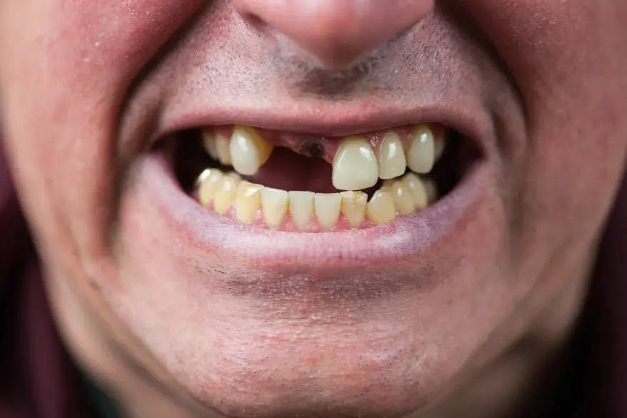 Groundbreaking tooth regrowing drug being developed: ‘Every dentist’s dream’