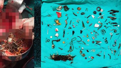 Man goes to hospital for a stomach ache, shocked doctors retrieve 60 household items from his gut