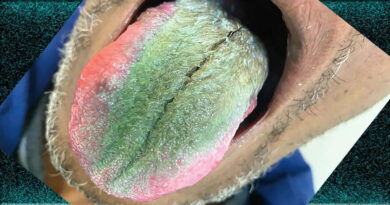 Smoker’s tongue sprouts green hair after years of smoking cigarettes