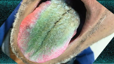 Smoker’s tongue sprouts green hair after years of smoking cigarettes