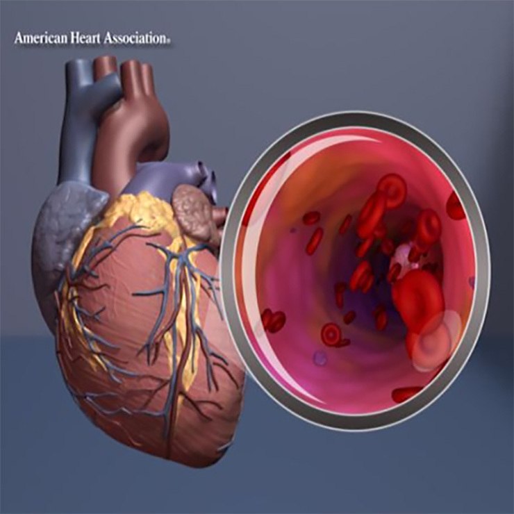 Graphic from the American Heart Association linking gum disease to arteries stiffening and clogging.