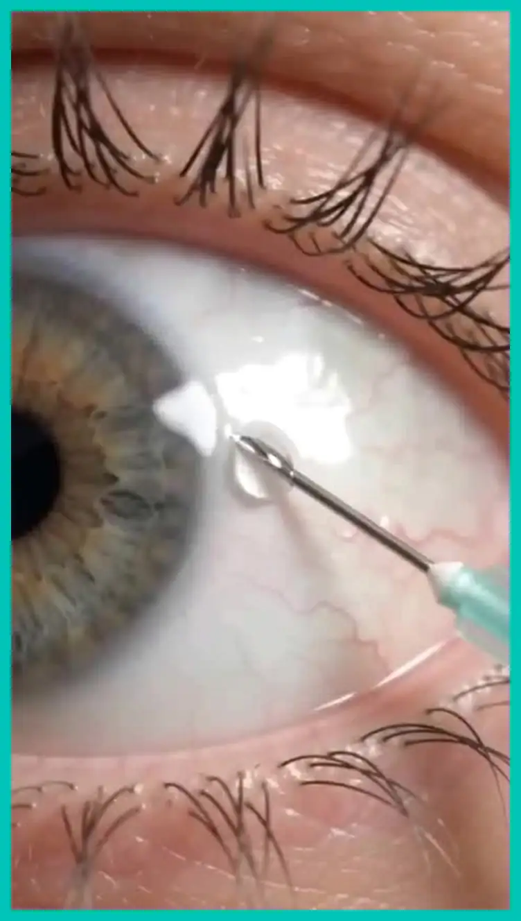 Teal-framed close view of an eye from an educational video about ocular anatomy